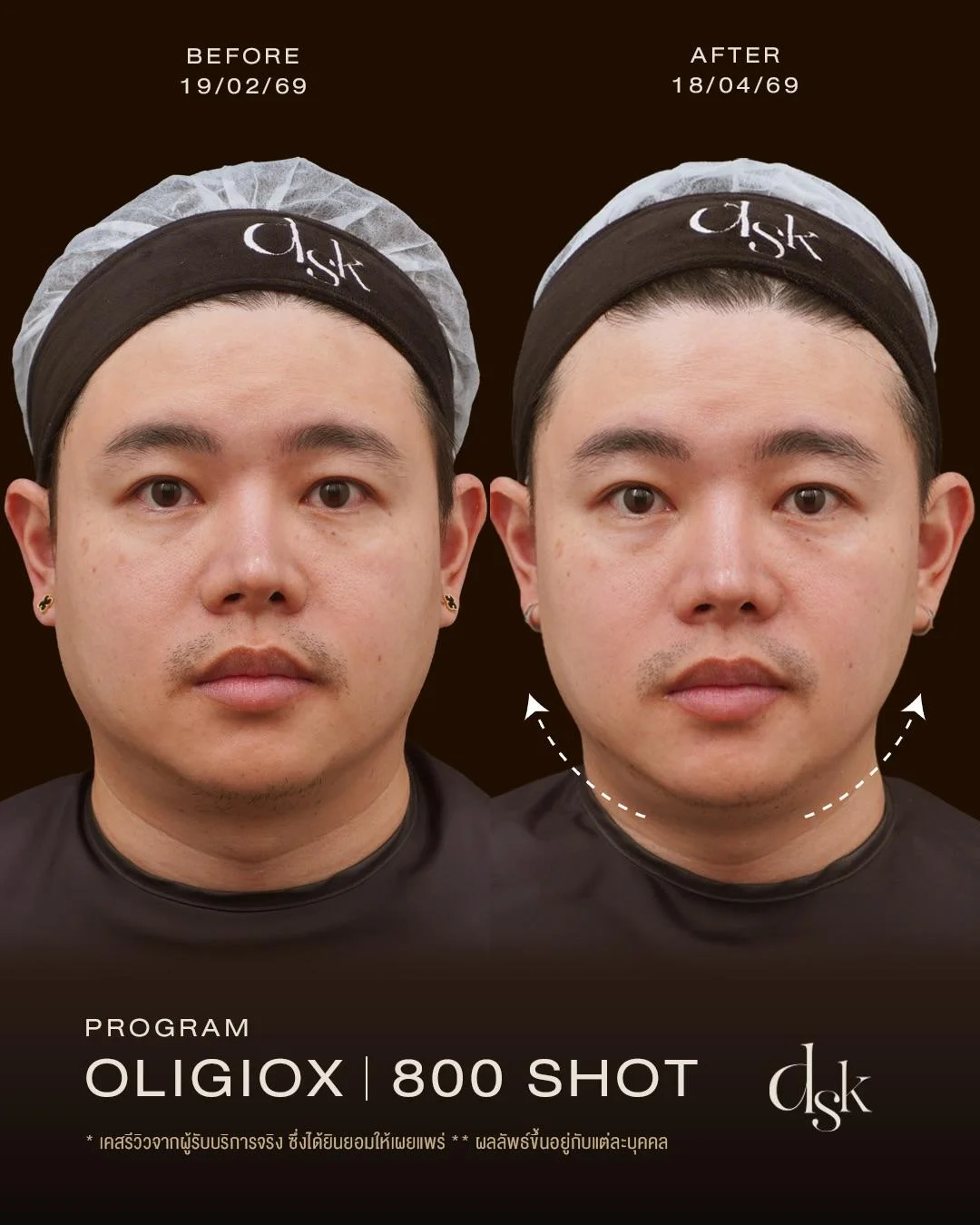 รีวิวโปรแกรม Oligio DSK Clinic : Before & After จากผู้ใช้บริการจริง