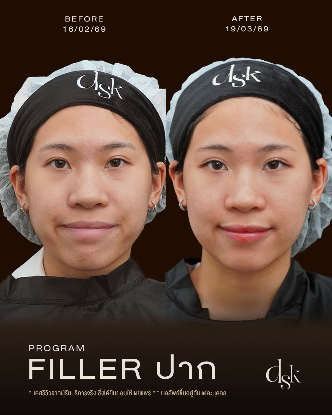 รีวิวโปรแกรมฟิลเลอร์ปาก