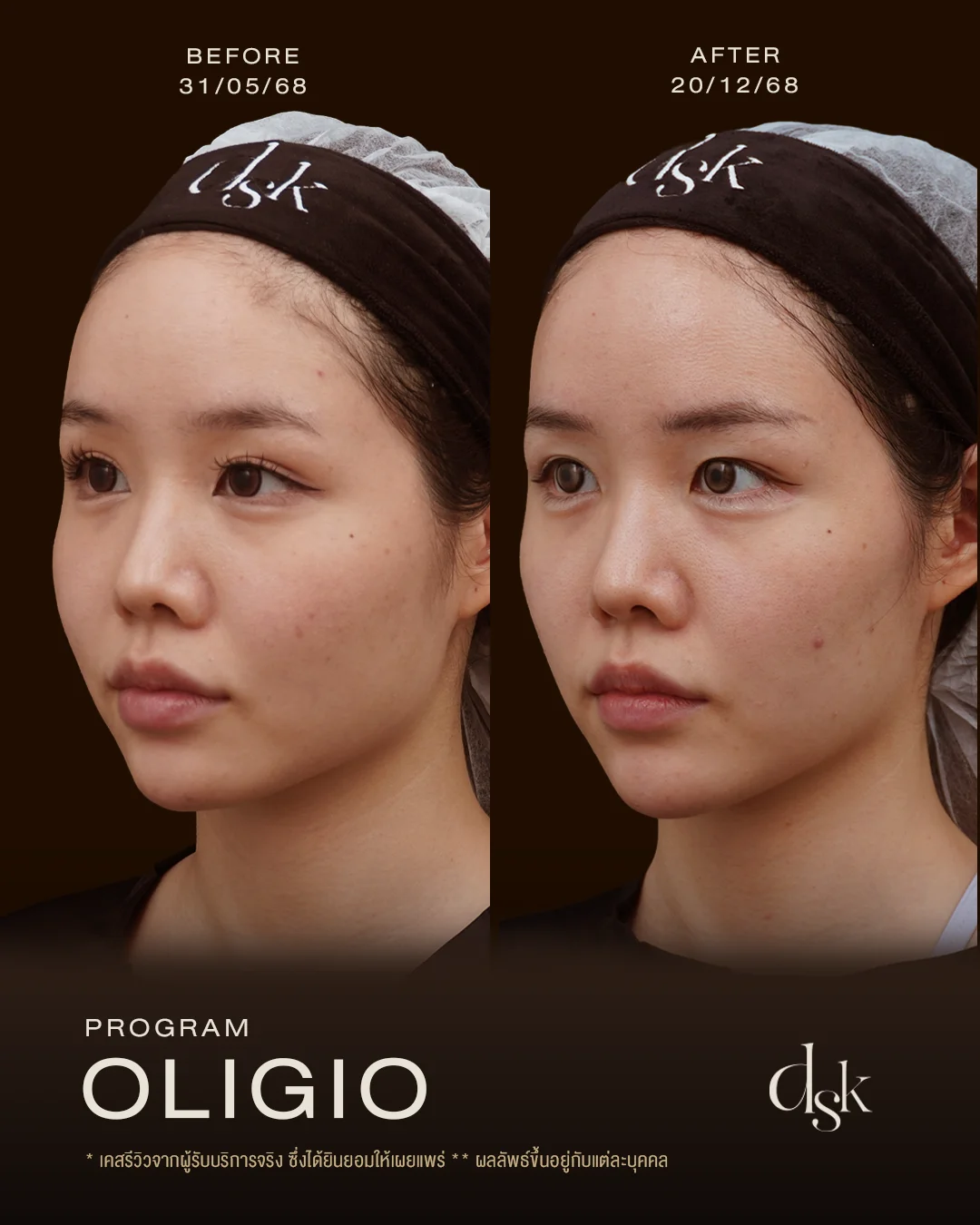 รีวิวโปรแกรม Oligio ที่ DSK Clinic