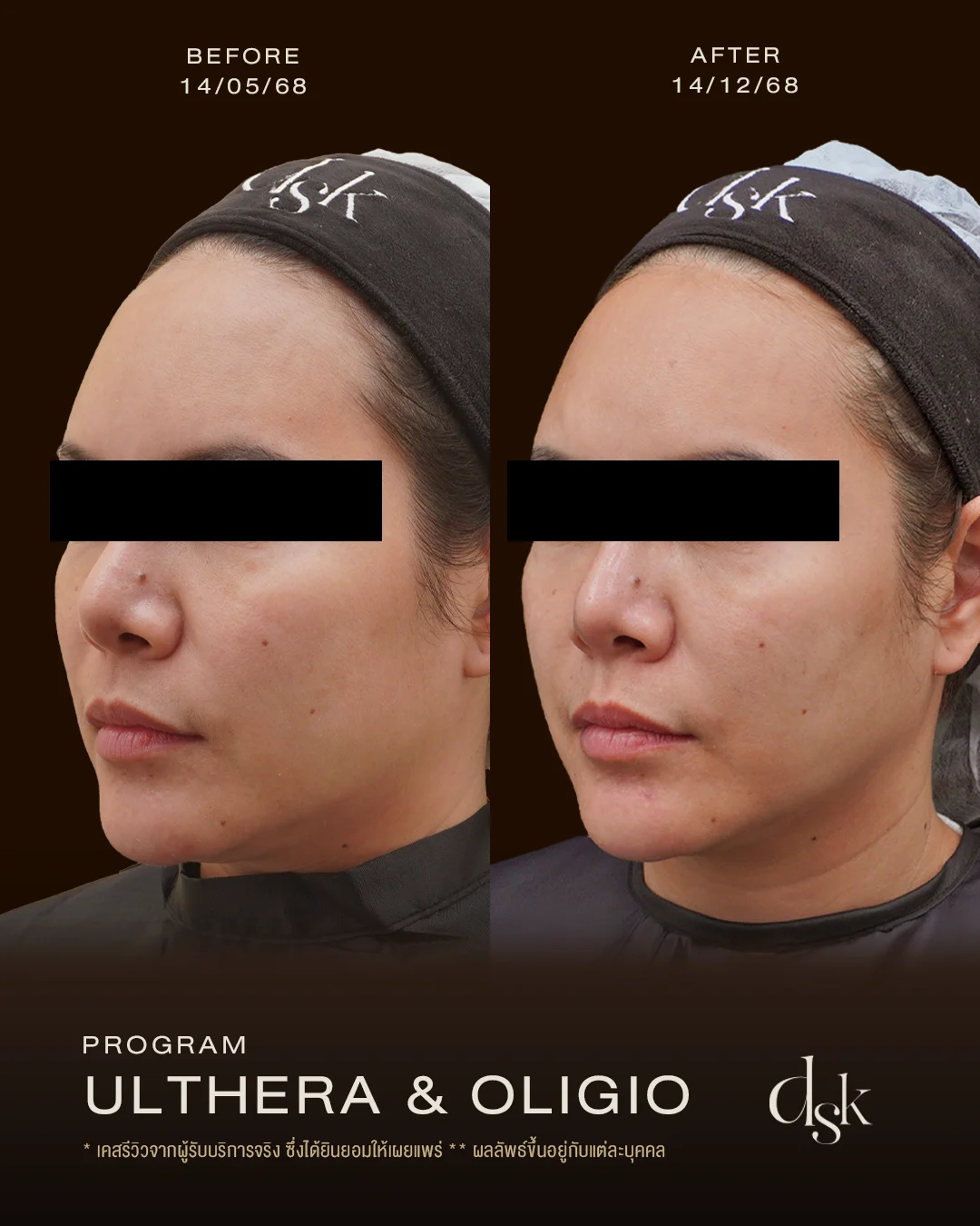 รีวิวหลังทำโปรแกรม Ulthera Prime ที่ DSK