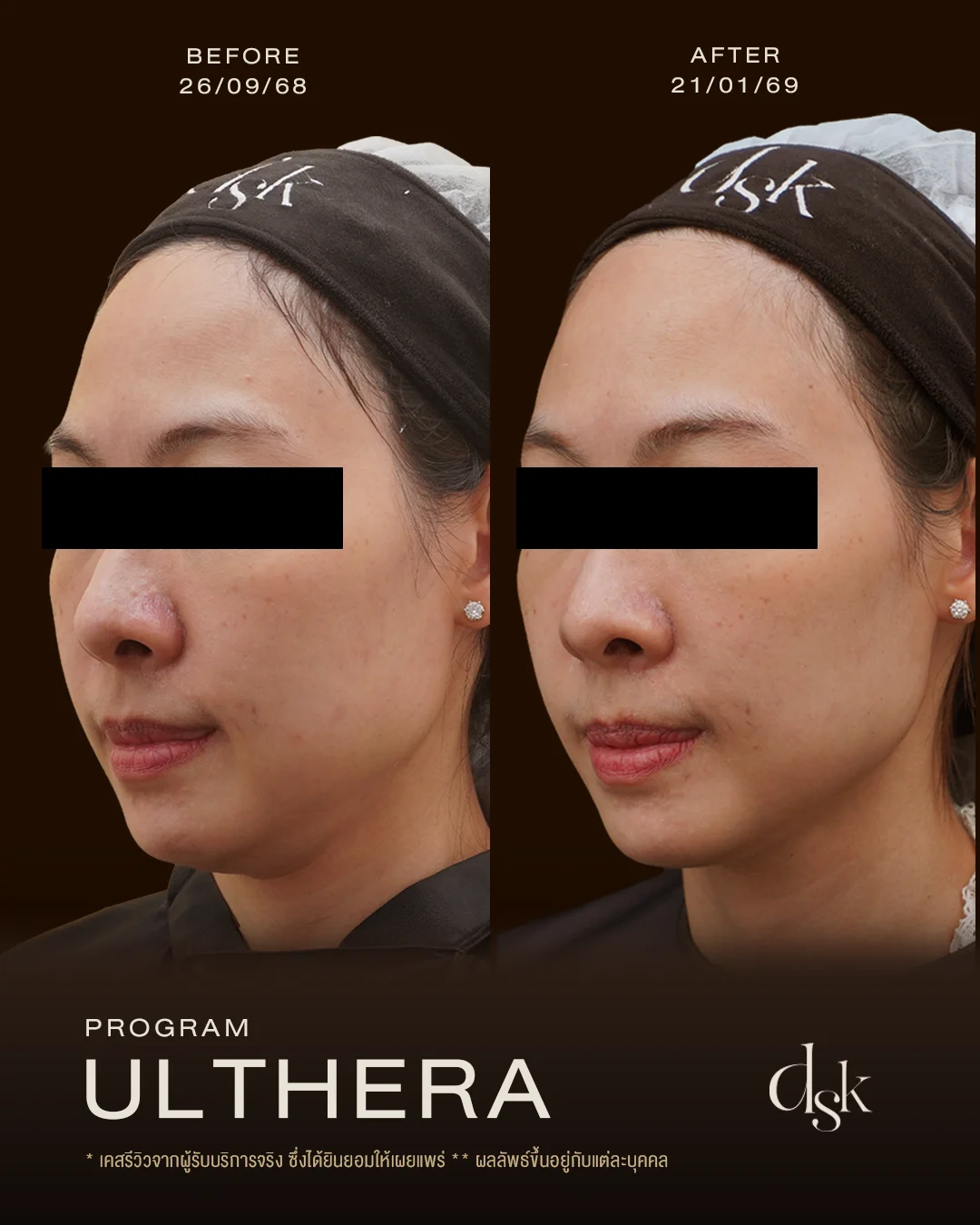 รีวิวหลังทำโปรแกรม Ulthera Prime ที่ DSK