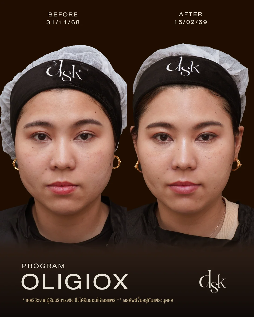 รีวิวผลลัพธ์หลังทำโปรแกรม Oligio และ OligioX ที่ DSK