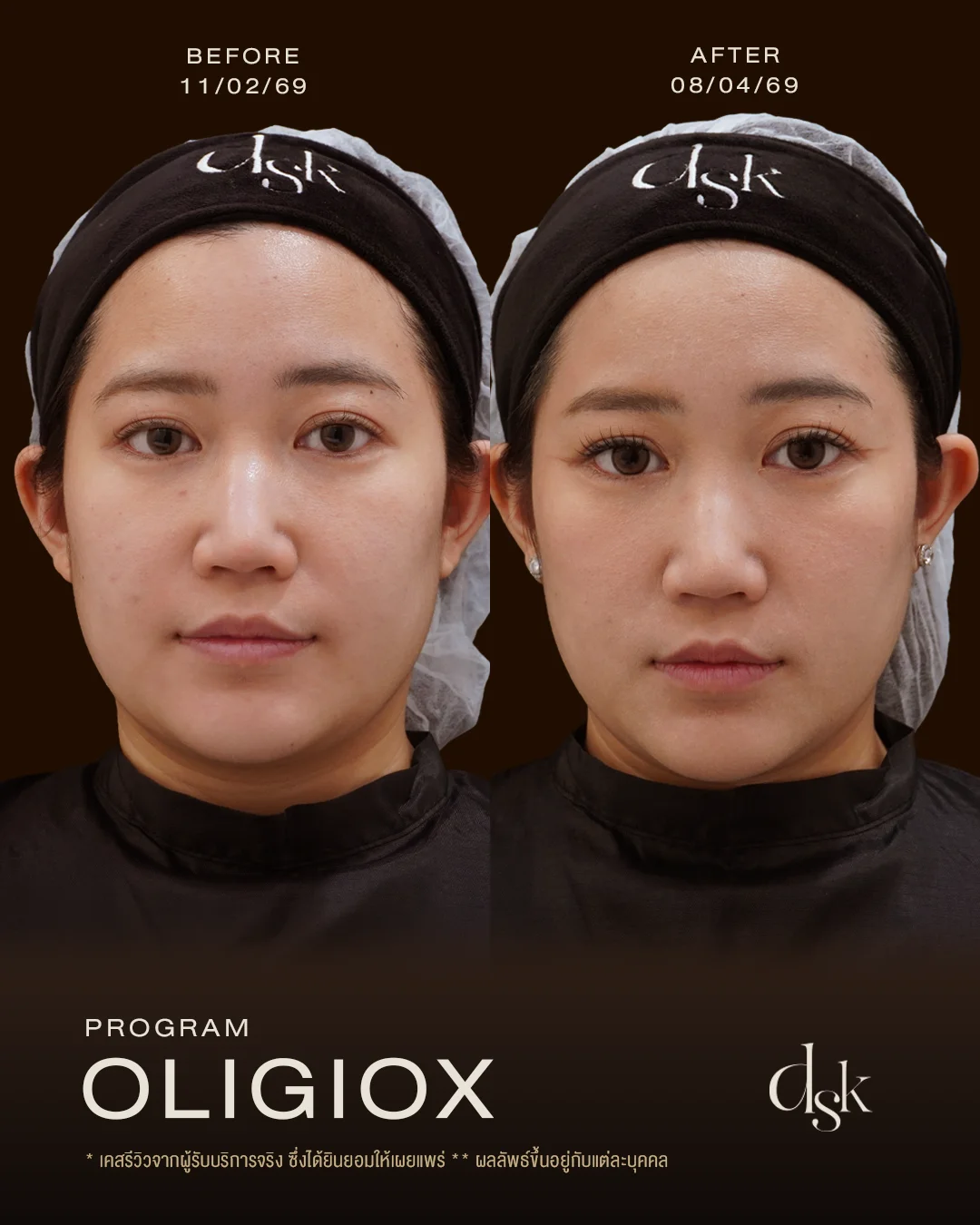 รีวิวผลลัพธ์หลังทำโปรแกรม Oligio และ OligioX ที่ DSK Clinic