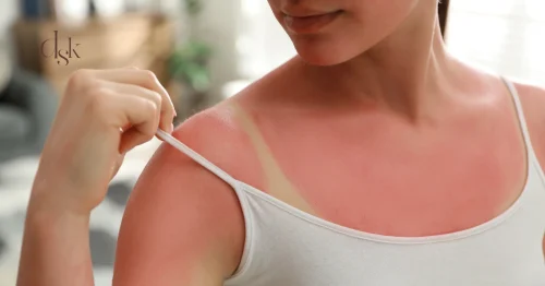 ผิวไหม้แดด (Sunburn) รับมืออย่างไร? เจาะลึกสาเหตุ วิธีรักษา และหัตถการกู้ผิวเร่งด่วน