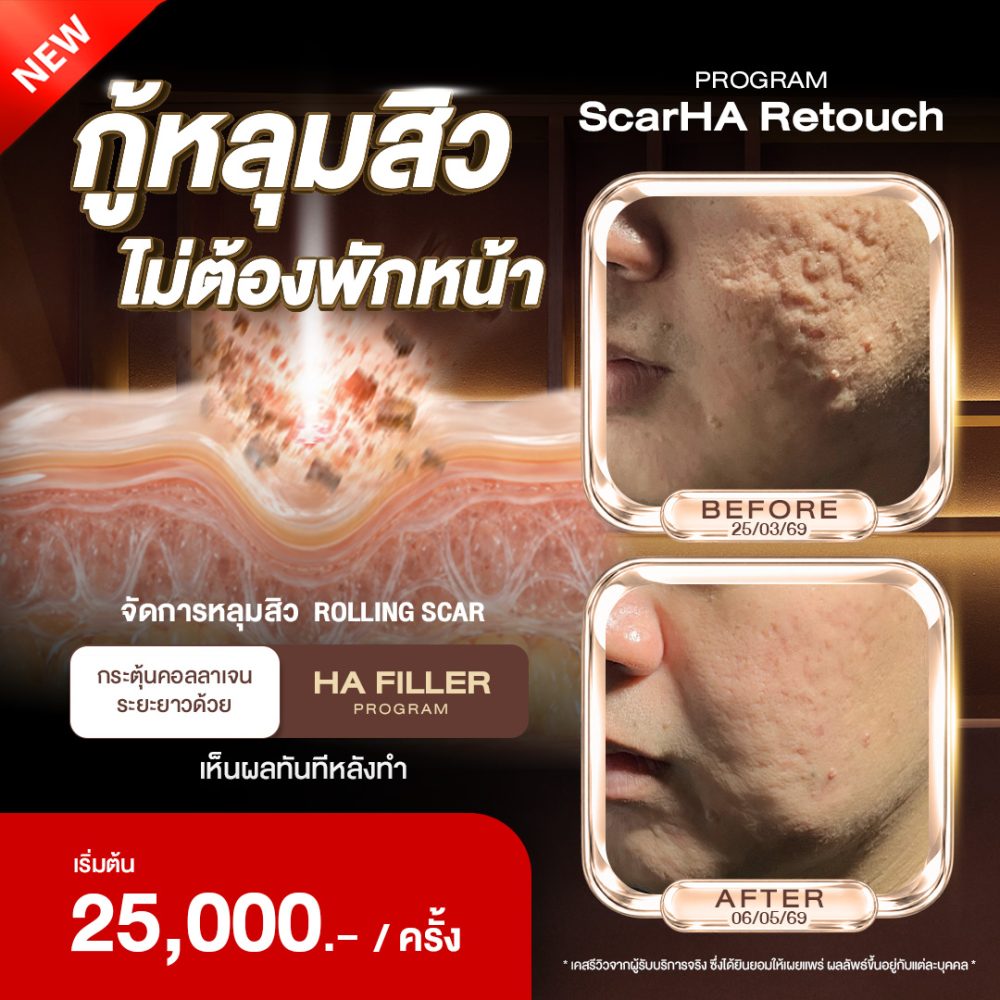 ScarHA กู้หลุมสิว ไม่ต้องพักหน้า2
